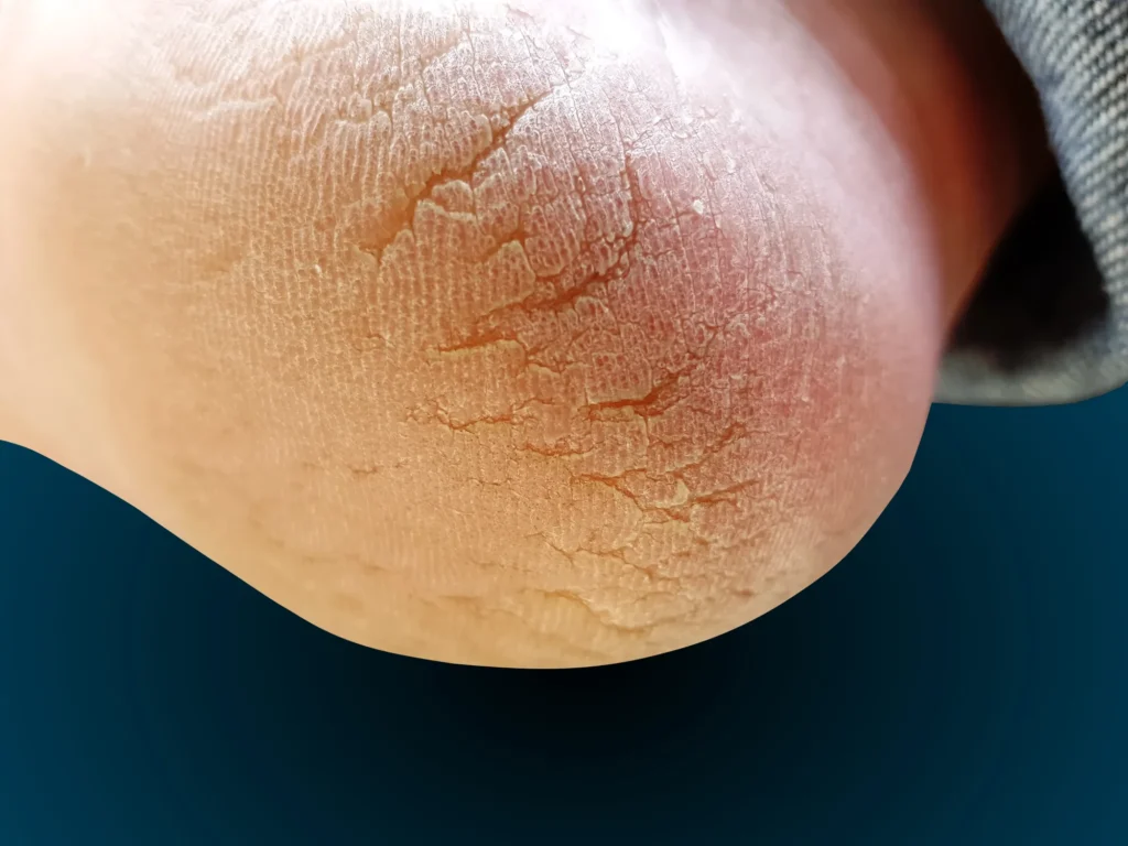 Descubre por qué aparecen las grietas en los talones y cómo prevenirlas. Si las fisuras persisten - Grietas en los talones: causas y cómo prevenir las fisuras