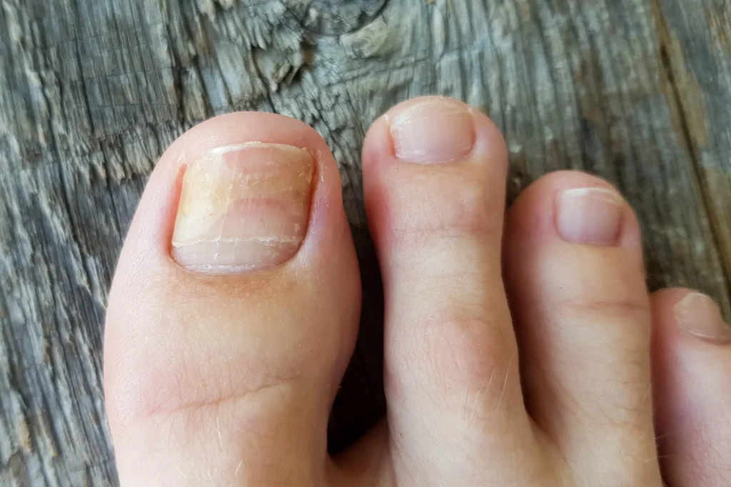 hongos en las uñas - Hongos en las uñas de los pies: síntomas, contagio y tratamiento