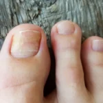 hongos en las uñas - Hongos en las uñas de los pies: síntomas, contagio y tratamiento