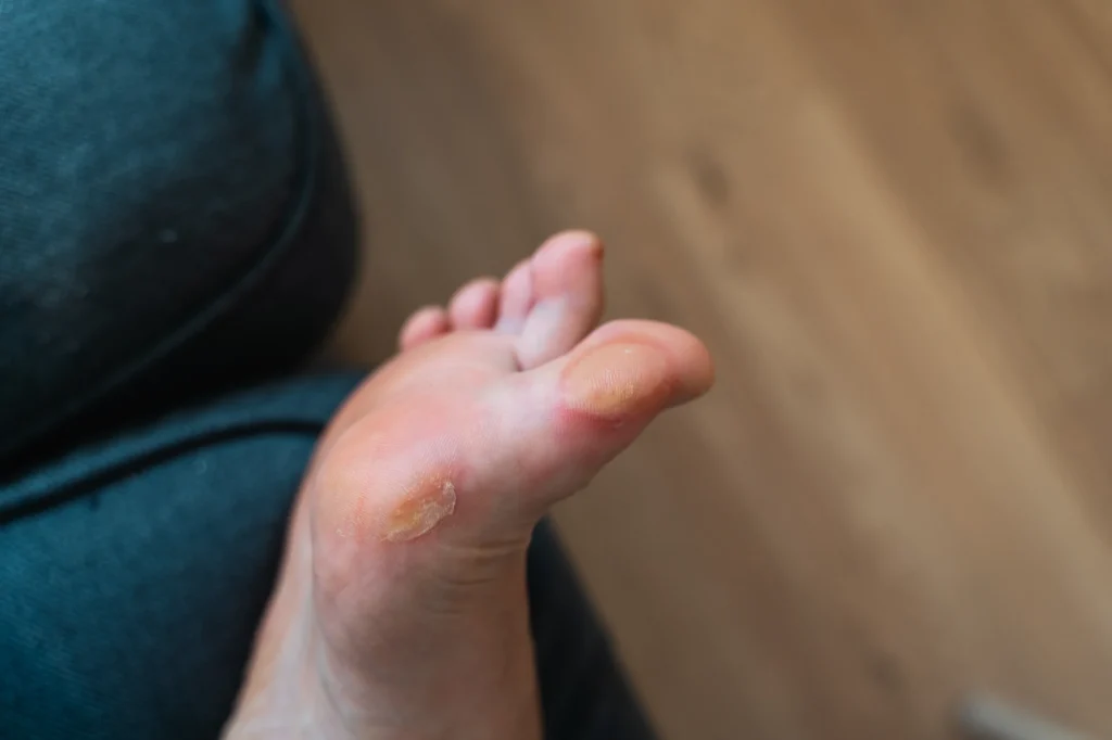 ¿Papiloma o callo? Cómo diferenciarlos y tratarlos correctamente 1 ¿Papiloma o callo en el pie? Descubre las diferencias - ¿Papiloma o callo? Cómo diferenciarlos y tratarlos correctamente