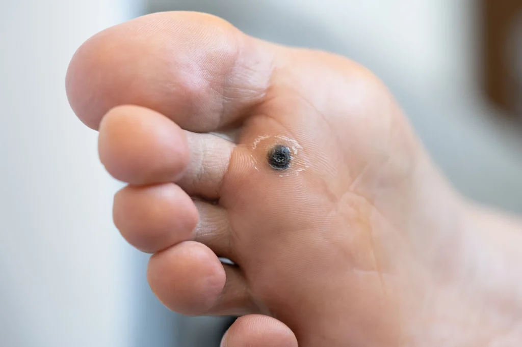 Helomas u ojos de gallo: qué son y cómo tratarlos 1 ¿Sufres helomas u ojos de gallo entre los dedos? Te explicamos sus causas y cómo eliminarlos de forma segura. Pide cita en Podología Olite. - Helomas u ojos de gallo: qué son y cómo tratarlos