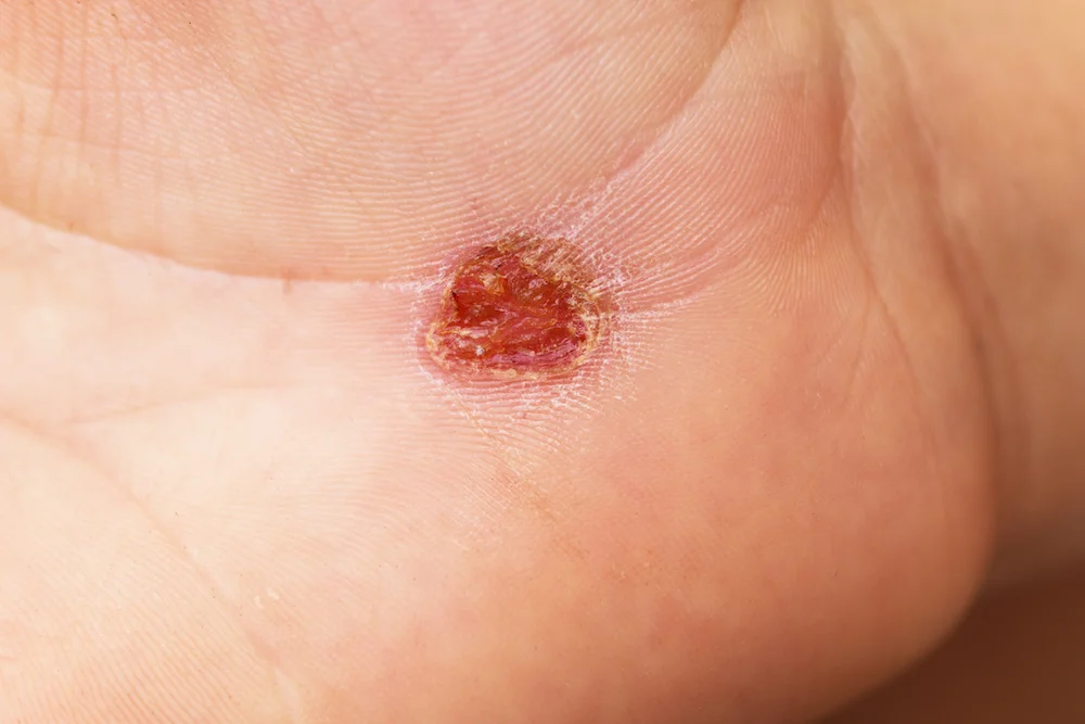Papiloma plantar o verruga: por qué aparece y cómo se quita 1 ¿Tienes un papiloma plantar? Te explicamos por qué aparece esta verruga en el pie y cómo eliminarla de forma segura. Pide cita en nuestra clínica de Olite. - Papiloma plantar o verruga: por qué aparece y cómo se quita