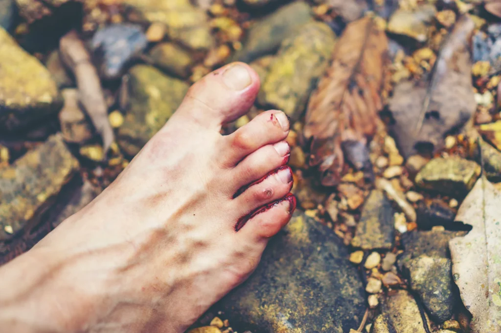 Uñas gruesas y amarillentas: por qué se engrosan y qué hacer 1 ¿Tienes uñas gruesas y amarillentas? Te explicamos por qué se engrosan y cómo el podólogo puede ayudarte. Pide cita en Olite. - Uñas gruesas y amarillentas: por qué se engrosan y qué hacer